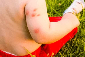 https://clinicahispanafamiliarrosenbergtexas.com/wp-content/uploads/2024/04/Treatment-of-Insect-Bites-min.png.webp