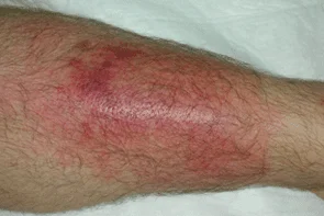 https://clinicahispanafamiliarrosenbergtexas.com/wp-content/uploads/2024/04/Treatment-of-Skin-and-Soft-Tissue-Injuries-min.png.webp