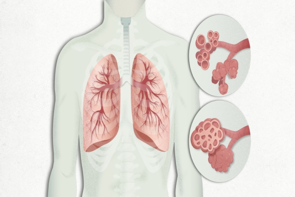 Fibrosis pulmonar