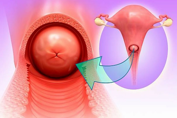 ¿Qué es la cervicitis?