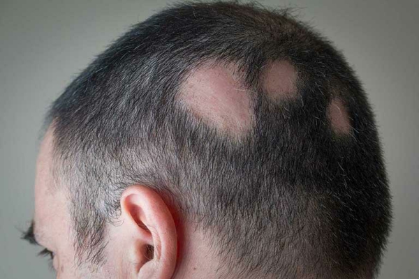 Alopecia