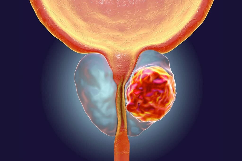 Cáncer de próstata