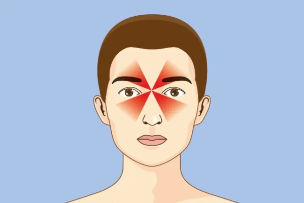 Dolor de cabeza por sinusitis