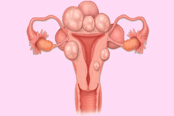 Fibromas uterinos
