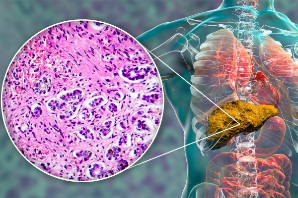 Insuficiencia hepática aguda